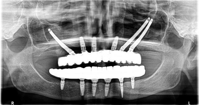 Implantologia i RTG 3D